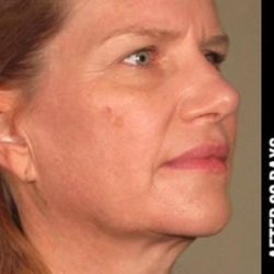 Ultherapy Before & After Patient #1559
